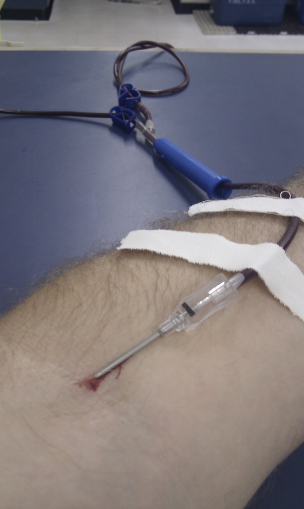 Eine Hand mit einem Kochsalzschlauch und einer Nadel daran, umgeben von Pflastern.