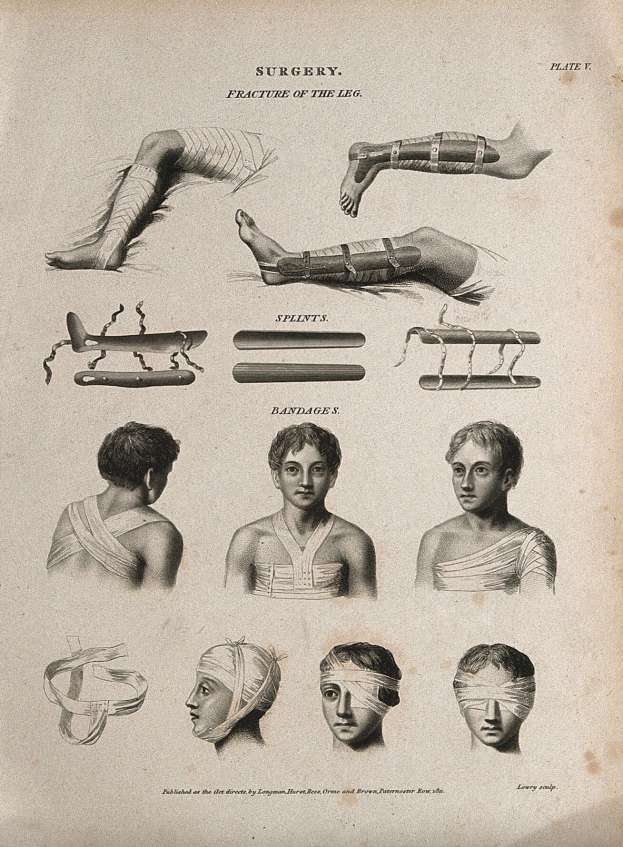 Ein Vintage-Illustration einer chirurgischen Prozedur, die die Beine eines Mannes und den Kopf einer Frau mit bandagierten Köpfen zeigt, begleitet von erklärendem Text.